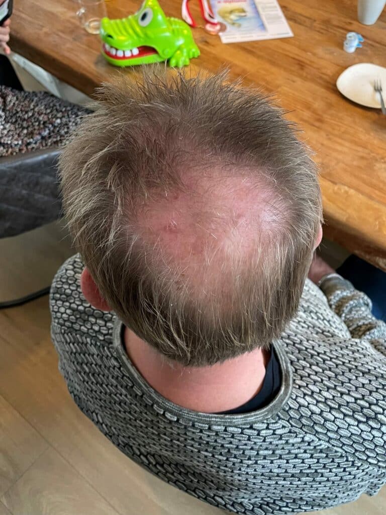 Dun Haar Man Imperio Haarvezels